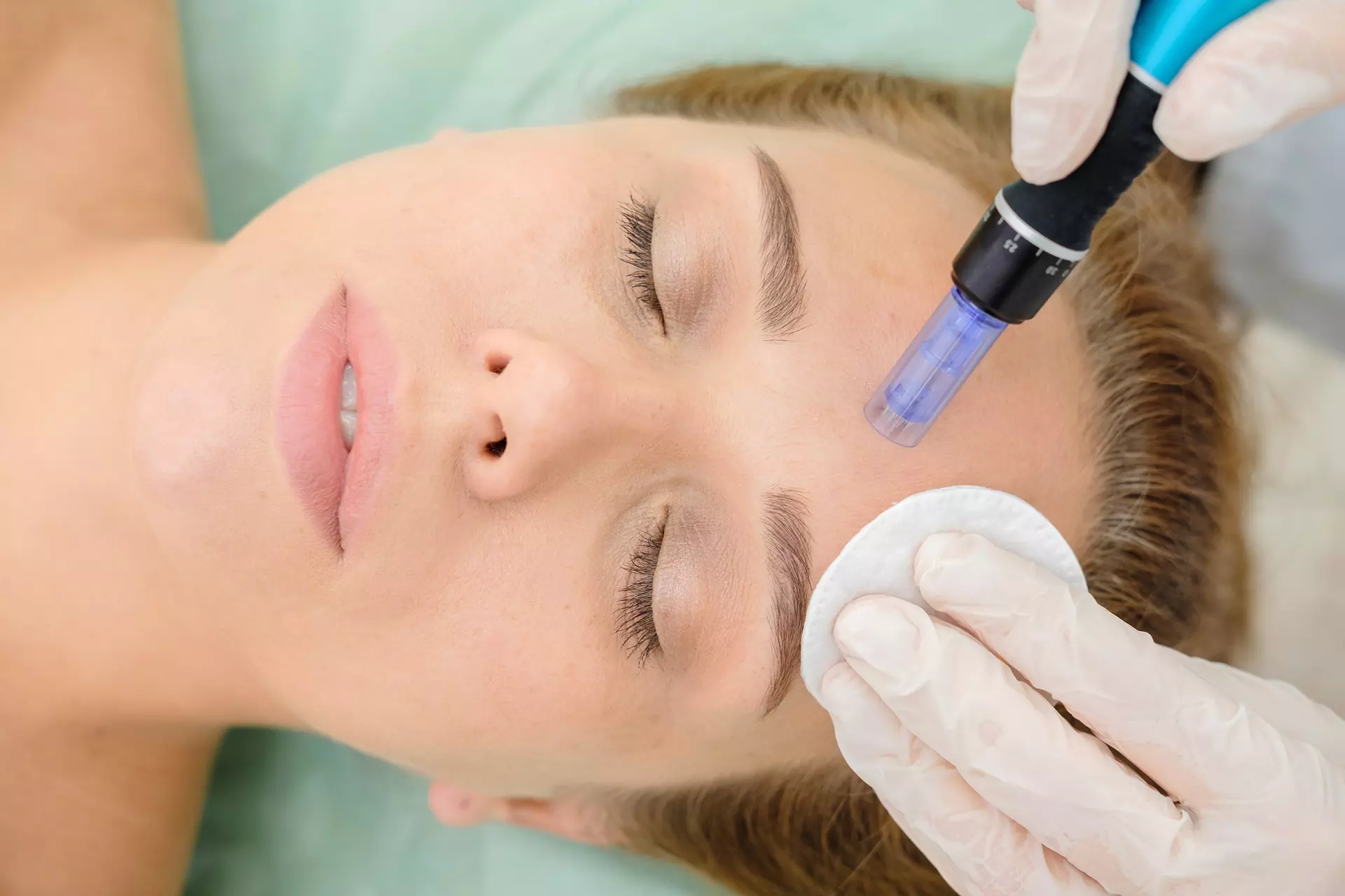 Microneedling treatment close-up